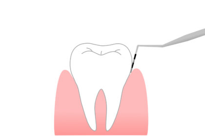 歯周病検査