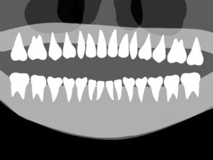 パノラマレントゲン